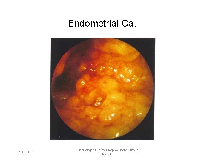 Endometrial Ca. 2015 -2016 Embriologie Clinica si Reproducere Umana Asistata 