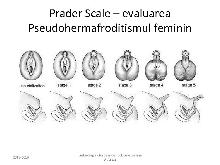 Prader Scale – evaluarea Pseudohermafroditismul feminin 2015 -2016 Embriologie Clinica si Reproducere Umana Asistata
