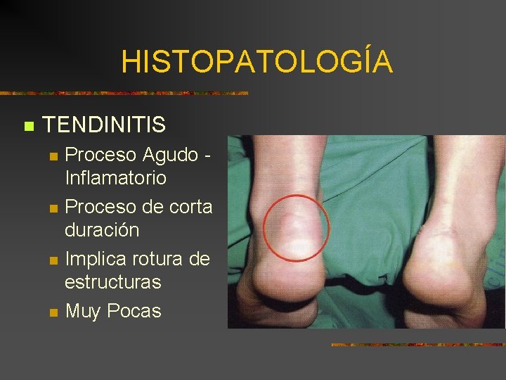 HISTOPATOLOGÍA n TENDINITIS n n Proceso Agudo Inflamatorio Proceso de corta duración Implica rotura