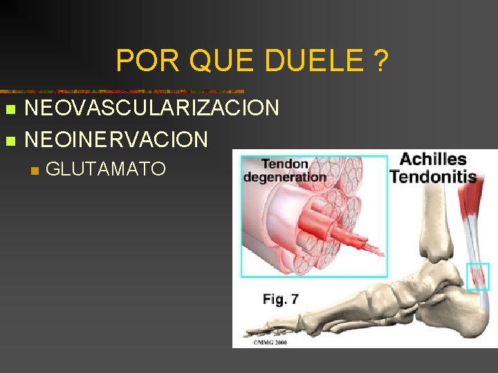 POR QUE DUELE ? n n NEOVASCULARIZACION NEOINERVACION n GLUTAMATO 