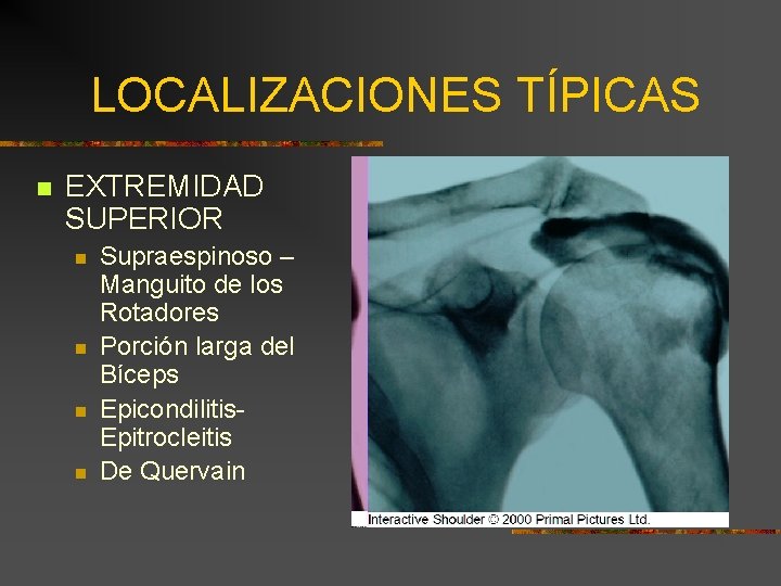 LOCALIZACIONES TÍPICAS n EXTREMIDAD SUPERIOR n n Supraespinoso – Manguito de los Rotadores Porción