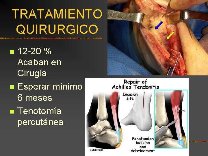 TRATAMIENTO QUIRURGICO n n n 12 -20 % Acaban en Cirugía Esperar mínimo 6