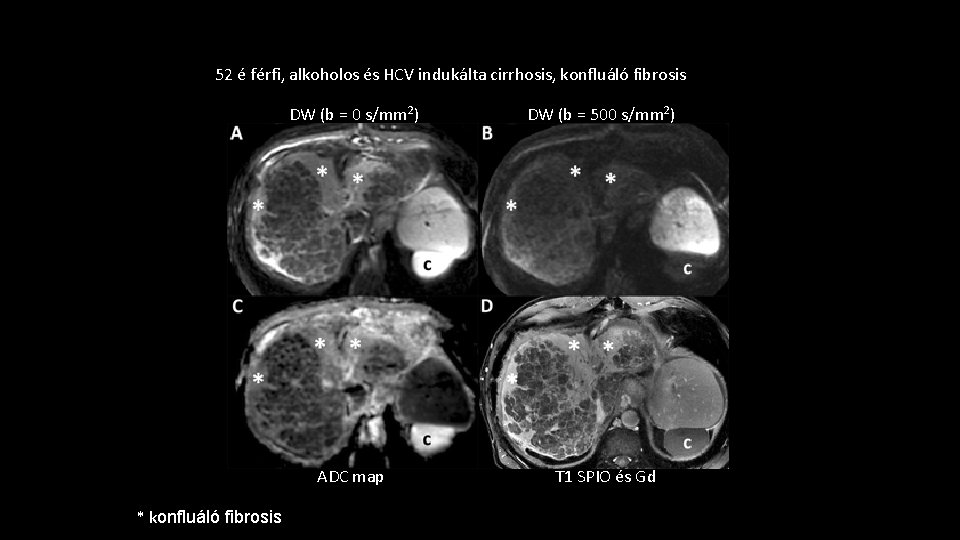 52 é férfi, alkoholos és HCV indukálta cirrhosis, konfluáló fibrosis * konfluáló fibrosis DW