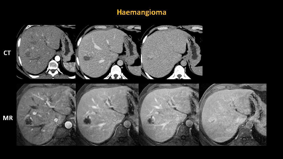 Haemangioma CT MR 