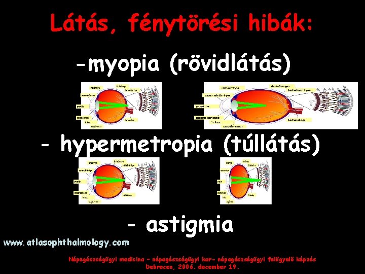 Látás, fénytörési hibák: -myopia (rövidlátás) - hypermetropia (túllátás) - astigmia www. atlasophthalmology. com Népegészségügyi