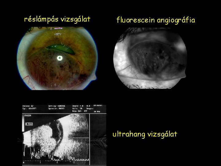réslámpás vizsgálat fluorescein angiográfia ultrahang vizsgálat 