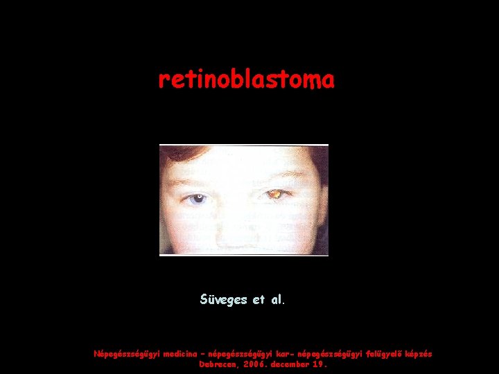 retinoblastoma Süveges et al. Népegészségügyi medicina – népegészségügyi kar- népegészségügyi felügyelő képzés Debrecen, 2006.