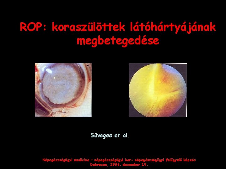 ROP: koraszülöttek látóhártyájának megbetegedése Süveges et al. Népegészségügyi medicina – népegészségügyi kar- népegészségügyi felügyelő