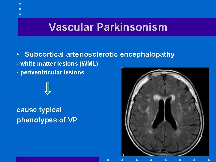 Vascular Parkinsonism • Subcortical arteriosclerotic encephalopathy - white matter lesions (WML) - periventricular lesions