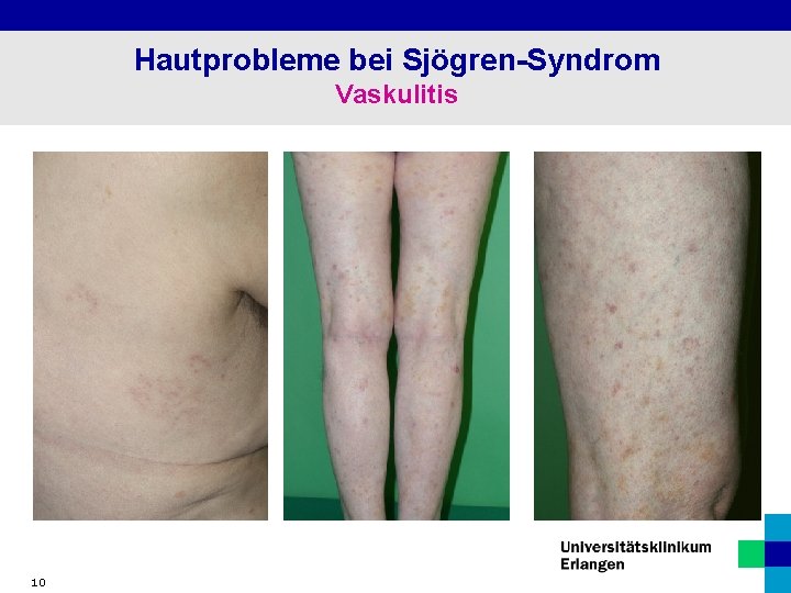 Hautprobleme bei Sjögren-Syndrom Vaskulitis 10 