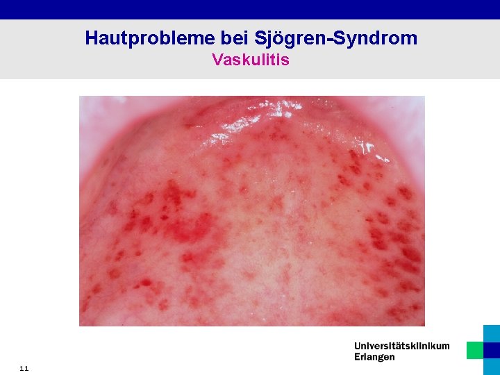 Hautprobleme bei Sjögren-Syndrom Vaskulitis 11 