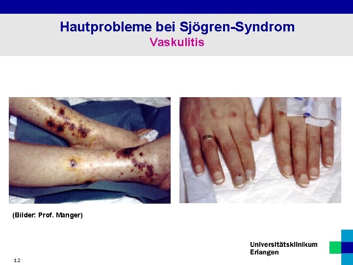 Hautprobleme bei Sjögren-Syndrom Vaskulitis (Bilder: Prof. Manger) 12 