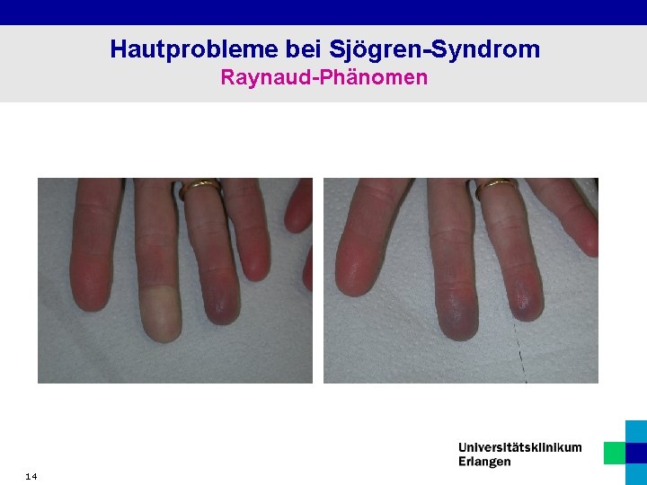 Hautprobleme bei Sjögren-Syndrom Raynaud-Phänomen 14 