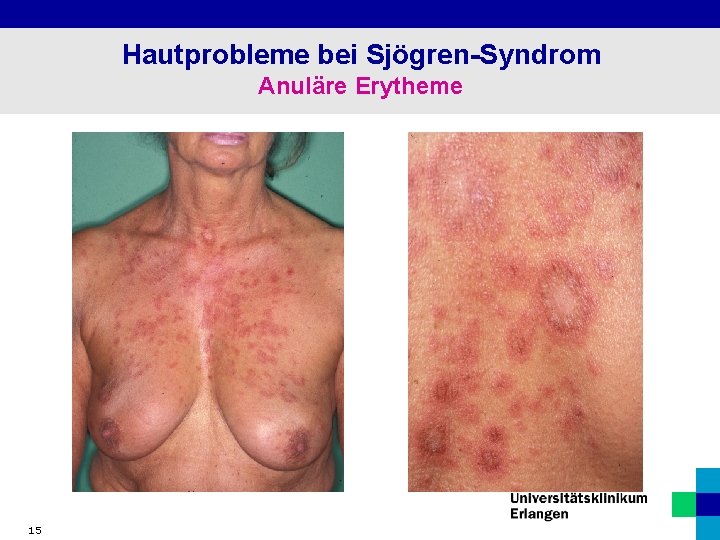 Hautprobleme bei Sjögren-Syndrom Anuläre Erytheme 15 