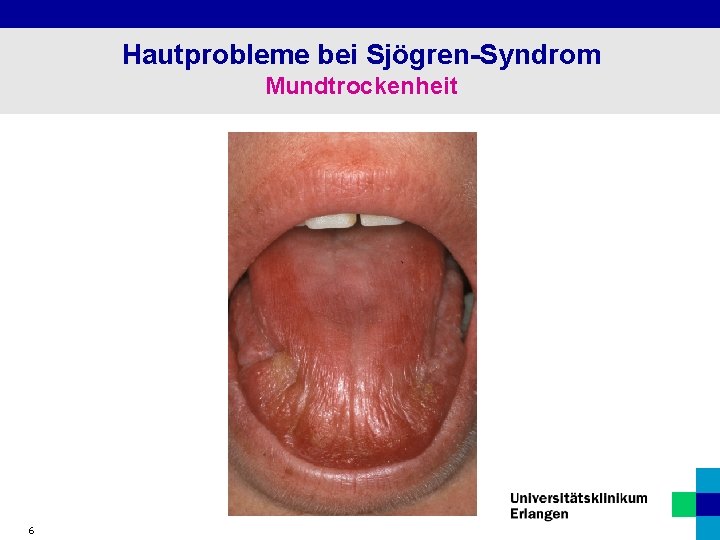 Hautprobleme bei Sjögren-Syndrom Mundtrockenheit 6 