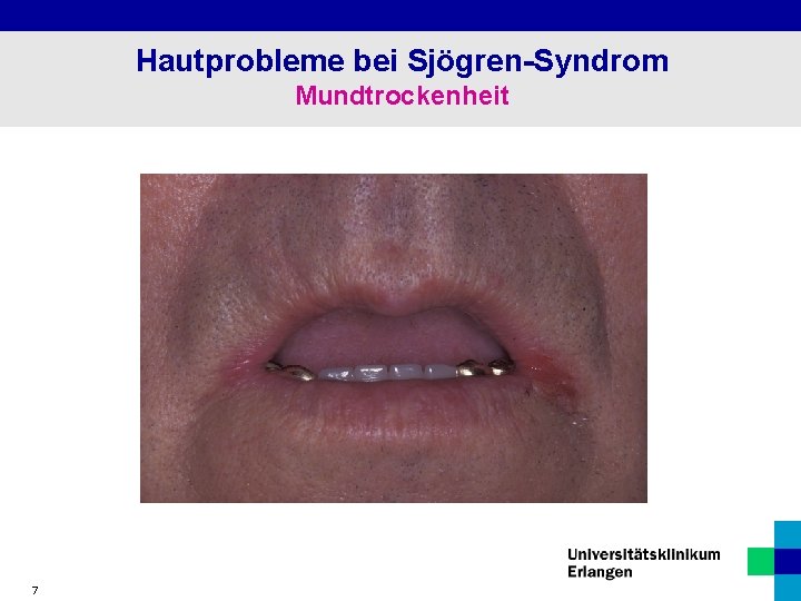 Hautprobleme bei Sjögren-Syndrom Mundtrockenheit 7 