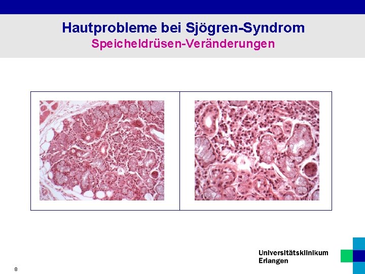 Hautprobleme bei Sjögren-Syndrom Speicheldrüsen-Veränderungen 8 