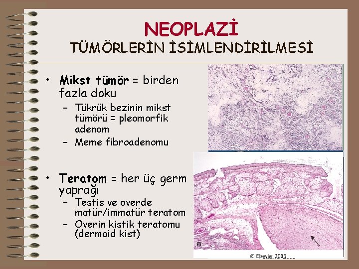 NEOPLAZİ TÜMÖRLERİN İSİMLENDİRİLMESİ • Mikst tümör = birden fazla doku – Tükrük bezinin mikst