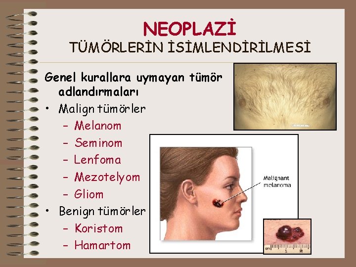 NEOPLAZİ TÜMÖRLERİN İSİMLENDİRİLMESİ Genel kurallara uymayan tümör adlandırmaları • Malign tümörler – Melanom –