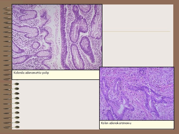 Kolonda adenomatöz polip Kolon adenokarsinomu 