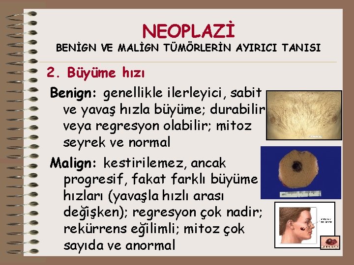 NEOPLAZİ BENİGN VE MALİGN TÜMÖRLERİN AYIRICI TANISI 2. Büyüme hızı Benign: genellikle ilerleyici, sabit