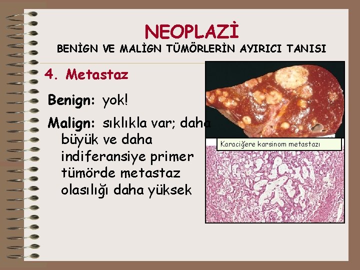 NEOPLAZİ BENİGN VE MALİGN TÜMÖRLERİN AYIRICI TANISI 4. Metastaz Benign: yok! Malign: sıklıkla var;