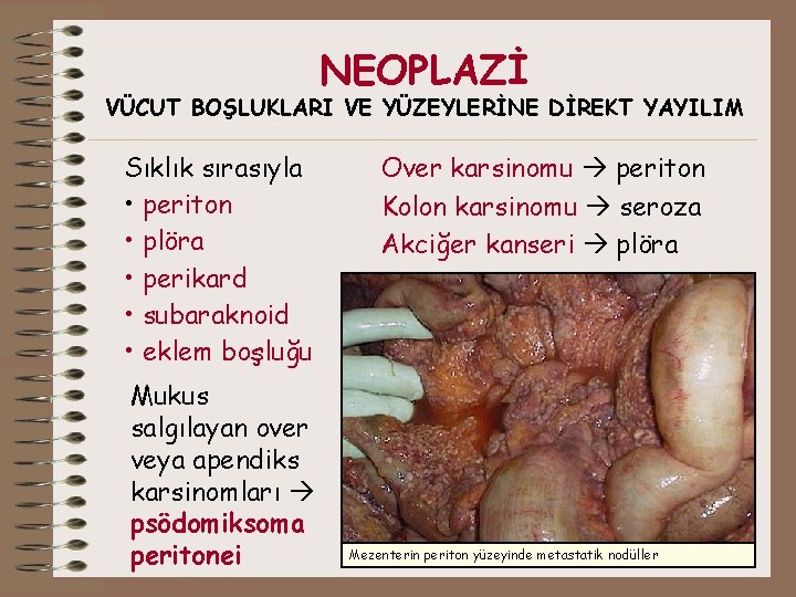 NEOPLAZİ VÜCUT BOŞLUKLARI VE YÜZEYLERİNE DİREKT YAYILIM Sıklık sırasıyla • periton • plöra •