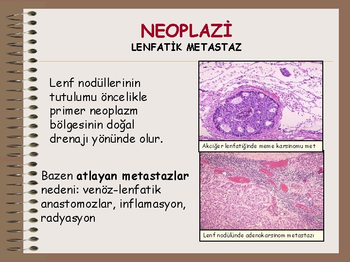 NEOPLAZİ LENFATİK METASTAZ Lenf nodüllerinin tutulumu öncelikle primer neoplazm bölgesinin doğal drenajı yönünde olur.