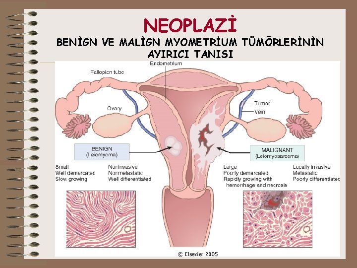 NEOPLAZİ BENİGN VE MALİGN MYOMETRİUM TÜMÖRLERİNİN AYIRICI TANISI 