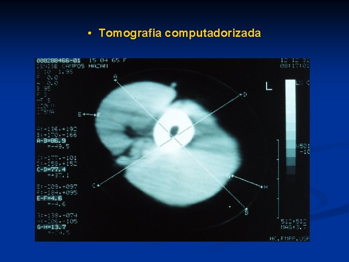 • Tomografia computadorizada 