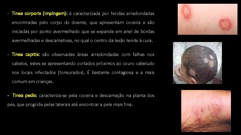 - Tinea corporis (impingem): é caracterizada por feridas arredondadas encontradas pelo corpo do doente,