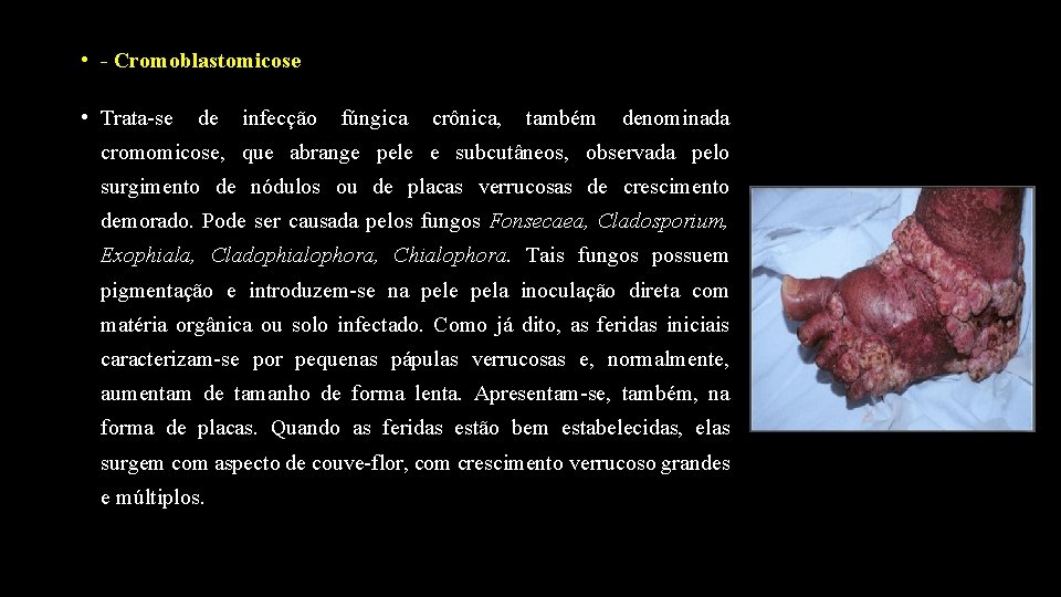  • - Cromoblastomicose • Trata-se de infecção fúngica crônica, também denominada cromomicose, que