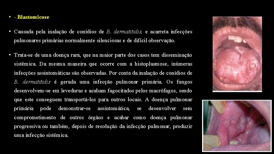  • - Blastomicose • Causada pela inalação de conídios de B. dermatitidis, e