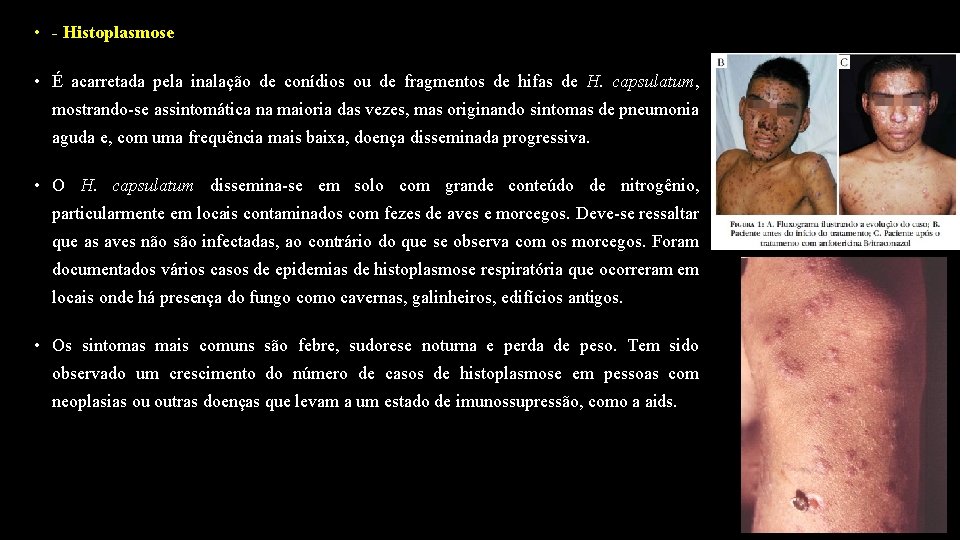  • - Histoplasmose • É acarretada pela inalação de conídios ou de fragmentos