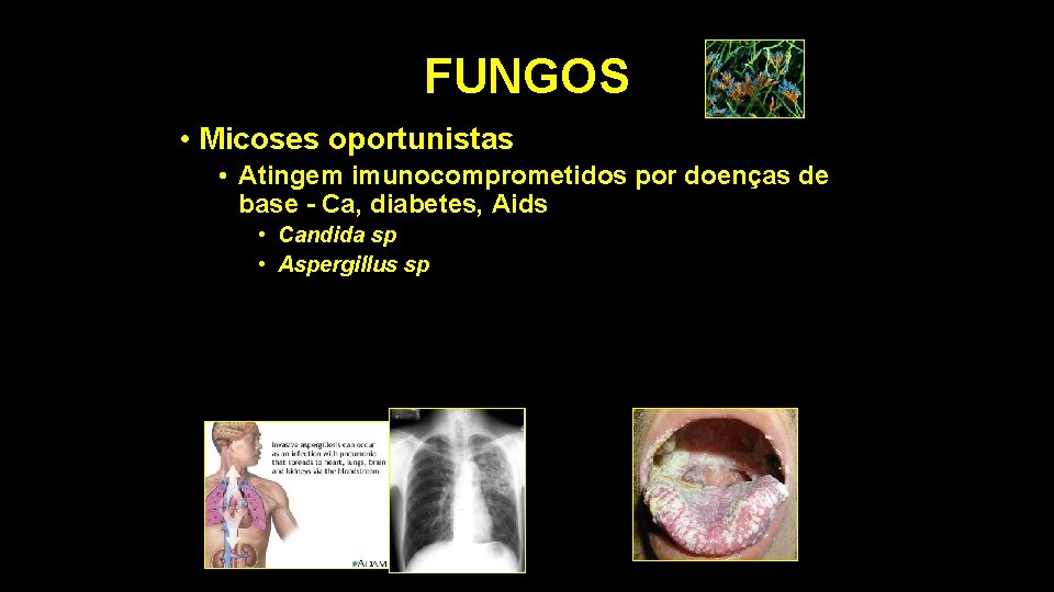 FUNGOS • Micoses oportunistas • Atingem imunocomprometidos por doenças de base - Ca, diabetes,