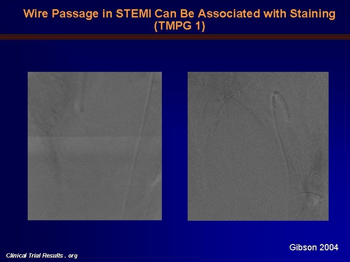 Wire Passage in STEMI Can Be Associated with Staining (TMPG 1) Clinical Trial Results.