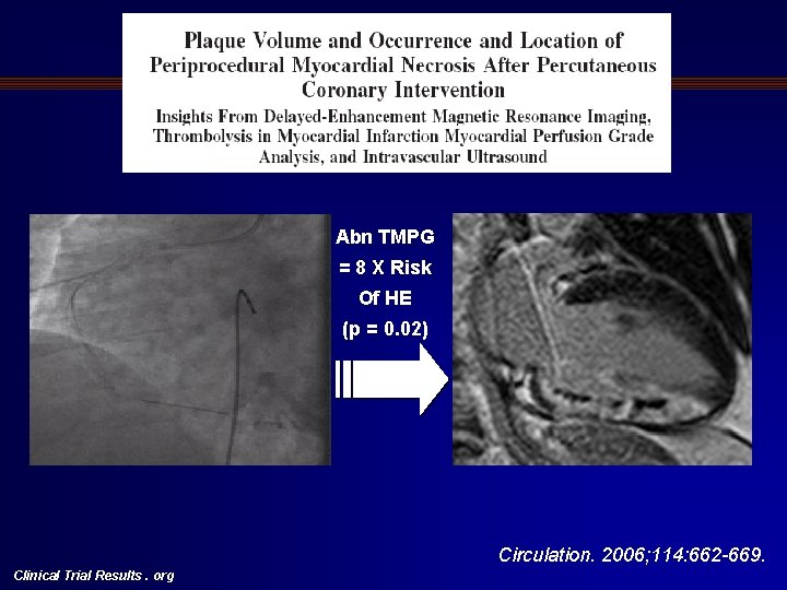 Two Chamber View Abn TMPG = 8 X Risk Of HE (p = 0.