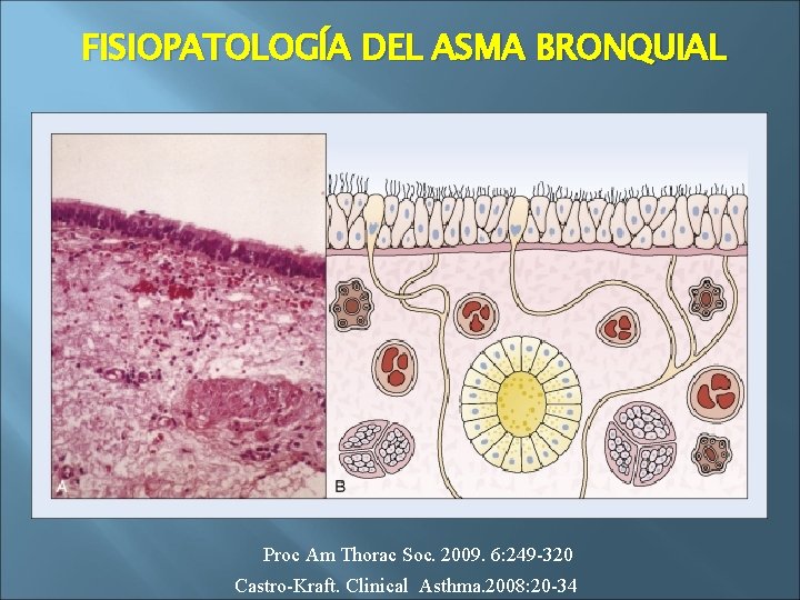 FISIOPATOLOGÍA DEL ASMA BRONQUIAL Proc Am Thorac Soc. 2009. 6: 249 -320 Castro-Kraft. Clinical