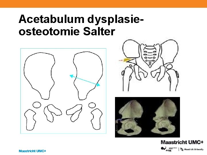 Acetabulum dysplasieosteotomie Salter 