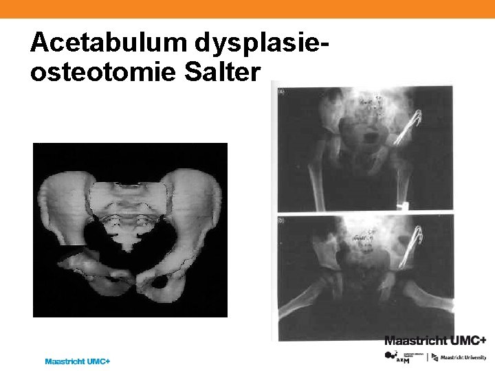 Acetabulum dysplasieosteotomie Salter 