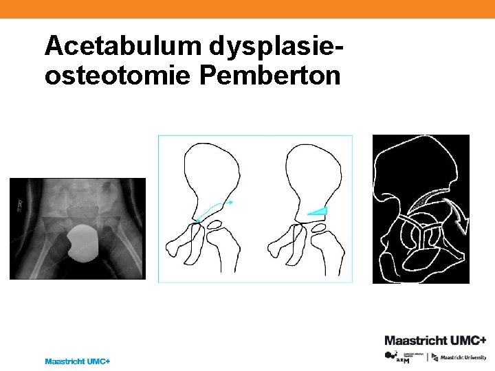 Acetabulum dysplasieosteotomie Pemberton 