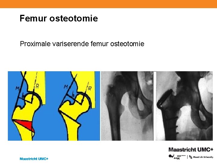 Femur osteotomie Proximale variserende femur osteotomie 