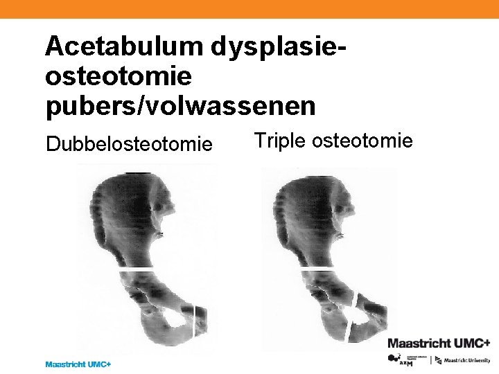 Acetabulum dysplasieosteotomie pubers/volwassenen Dubbelosteotomie Triple osteotomie 