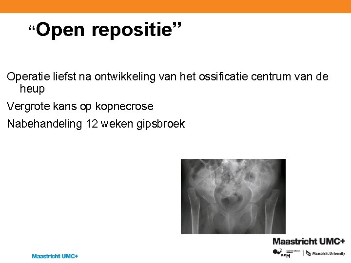 “Open repositie” Operatie liefst na ontwikkeling van het ossificatie centrum van de heup Vergrote