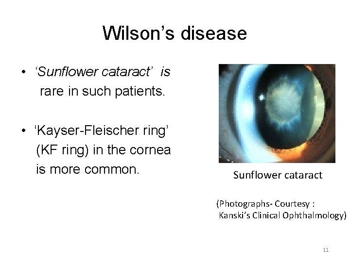 Wilson’s disease • ‘Sunflower cataract’ is rare in such patients. • ‘Kayser-Fleischer ring’ (KF
