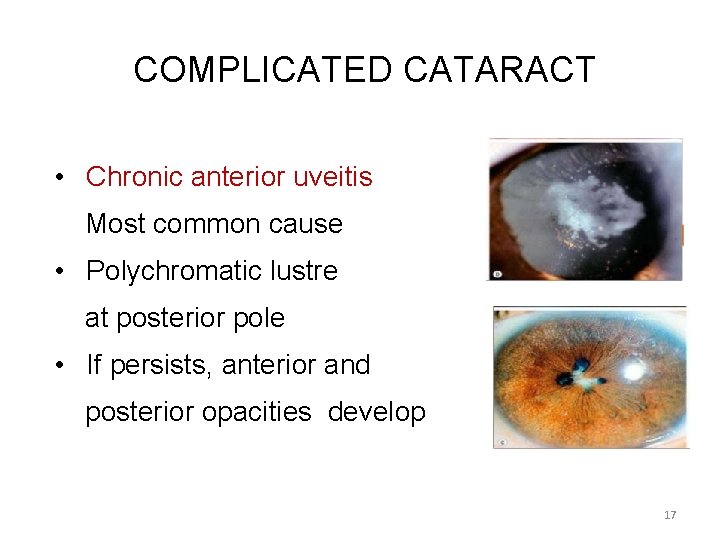 COMPLICATED CATARACT • Chronic anterior uveitis Most common cause • Polychromatic lustre at posterior