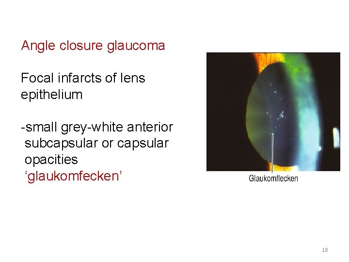 Angle closure glaucoma Focal infarcts of lens epithelium -small grey-white anterior subcapsular or capsular