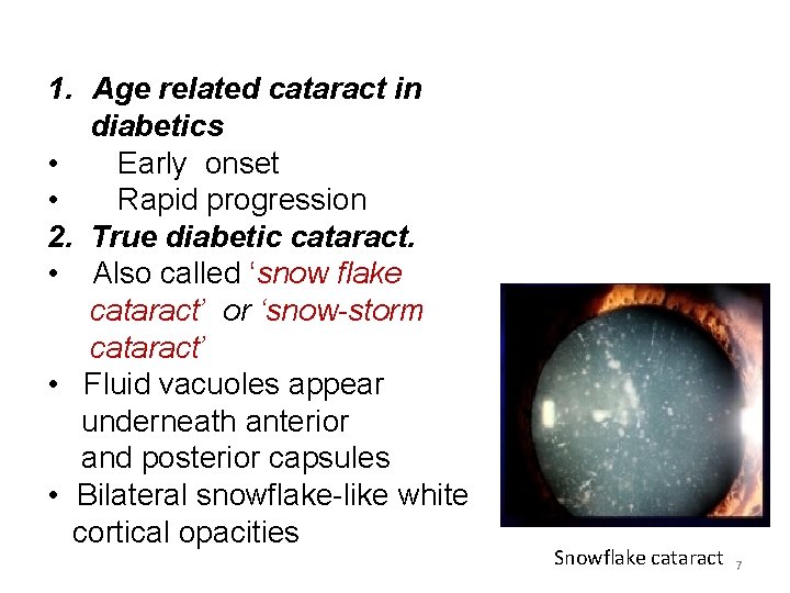 1. Age related cataract in diabetics • Early onset • Rapid progression 2. True