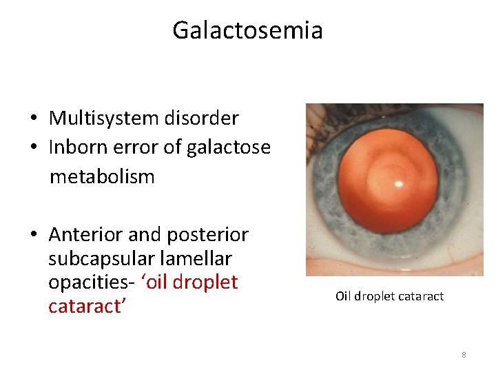 Galactosemia • Multisystem disorder • Inborn error of galactose metabolism • Anterior and posterior