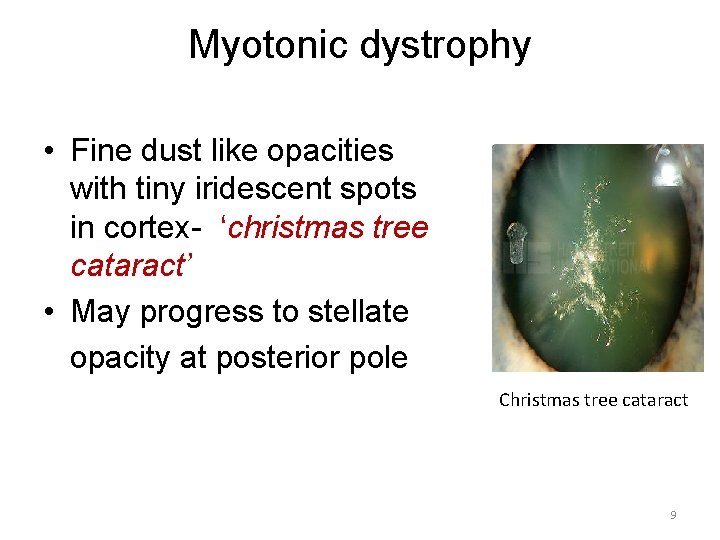 Myotonic dystrophy • Fine dust like opacities with tiny iridescent spots in cortex- ‘christmas